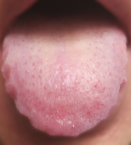 齿痕舌 齿痕舌