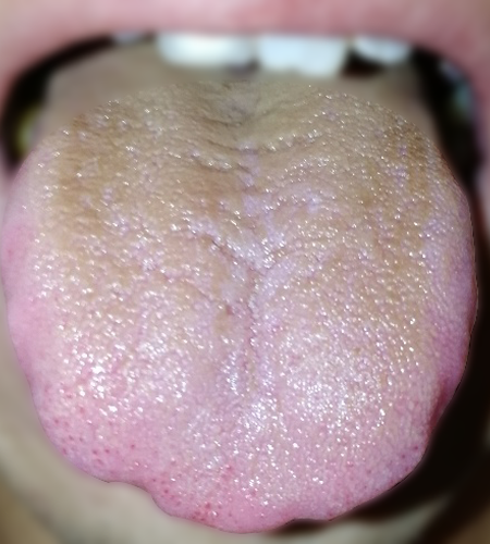 黄苔 黄苔
