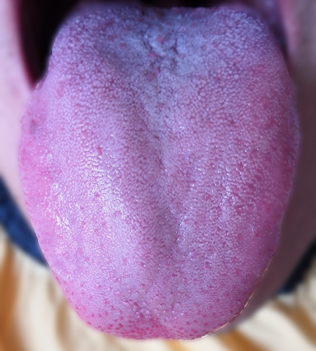 紫舌 紫舌